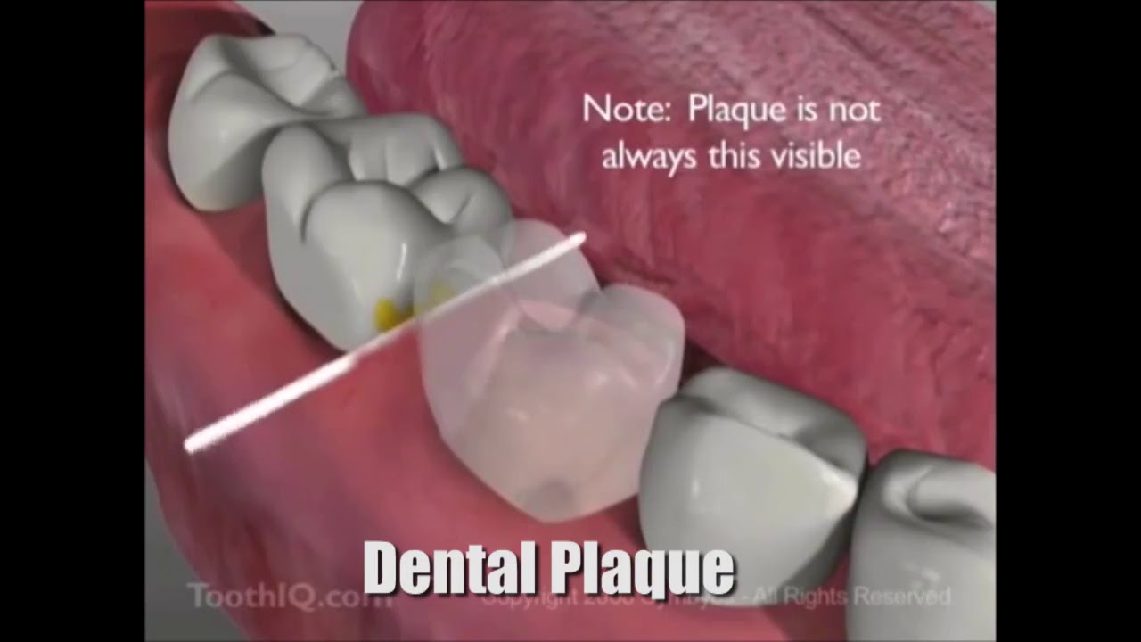 Dental Plaque – Dr. Charlene Reid