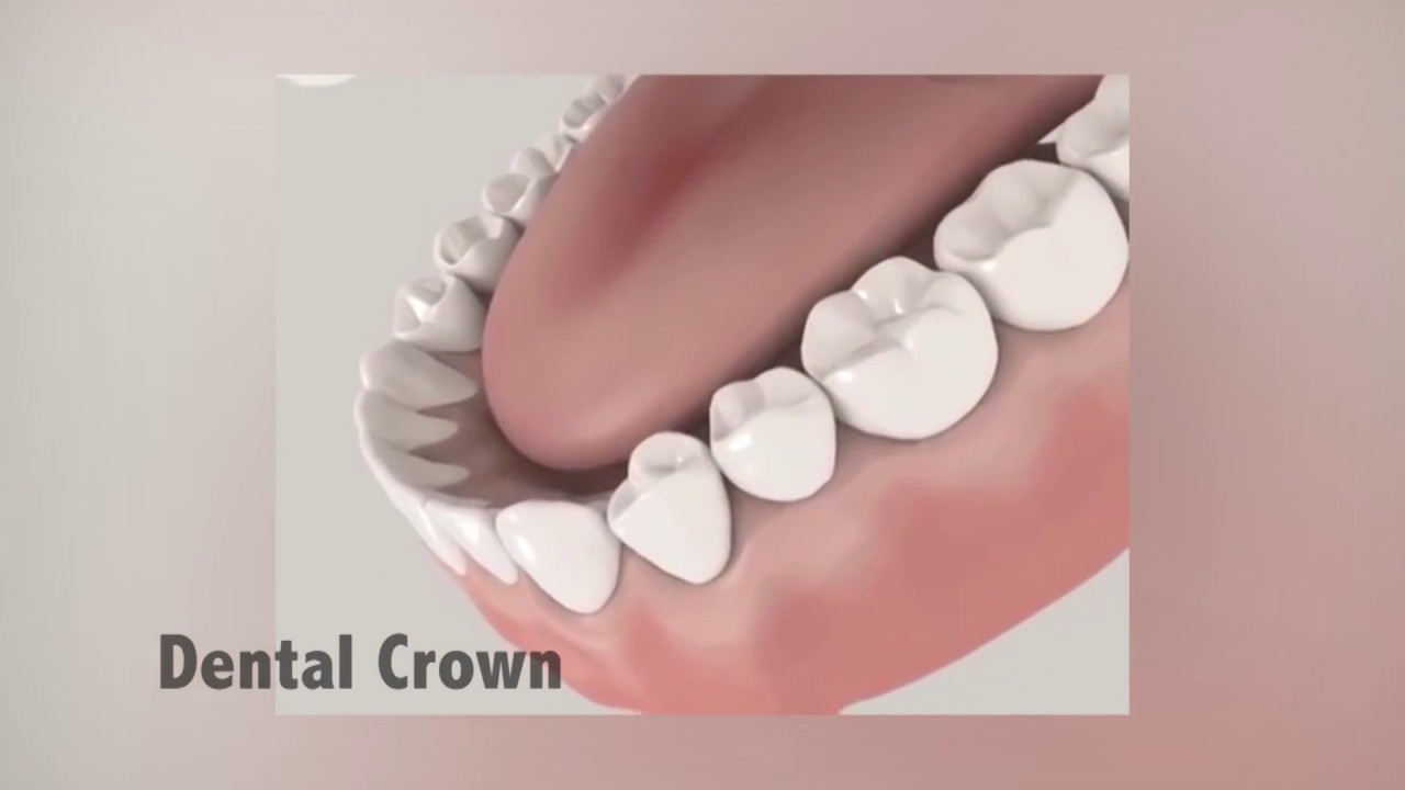 Dental Crown – Dr. Charlene Reid