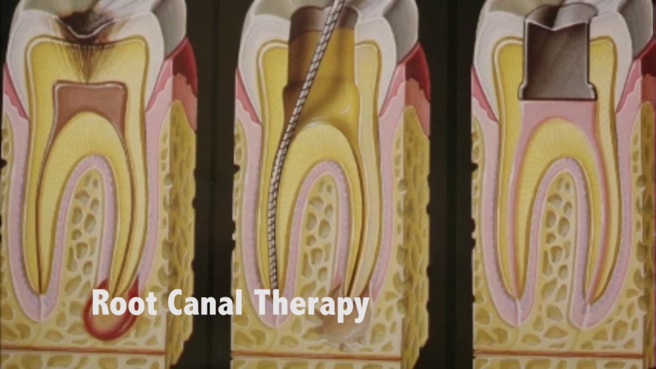 Root Canal Therapy – Dr. Charlene Reid