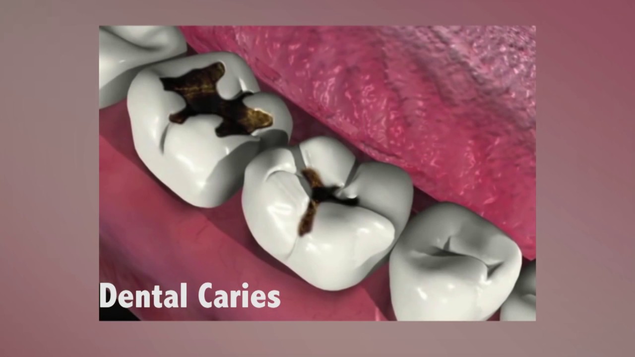 Dental Caries – Dr. Charlene Reid